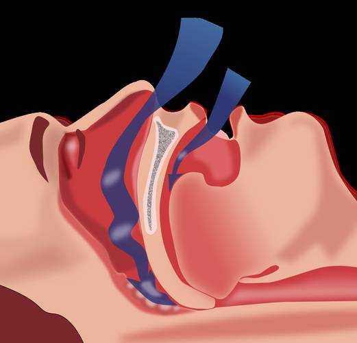 sleep apnea 2