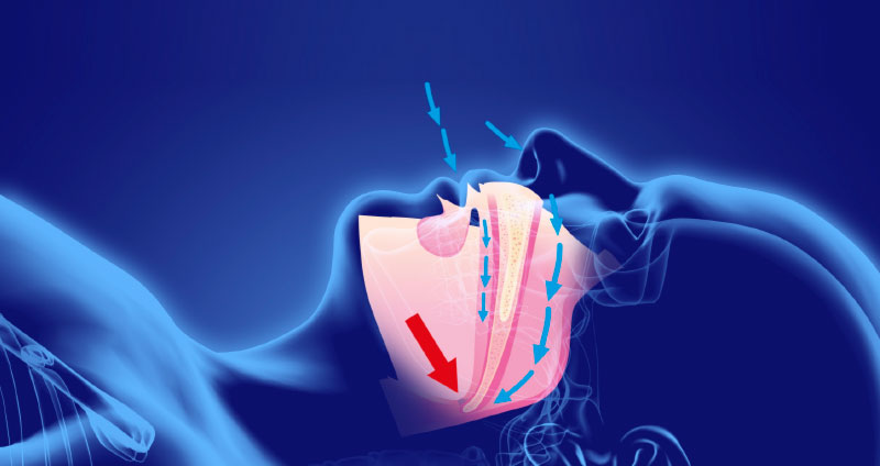 apnea obstructiva sueno