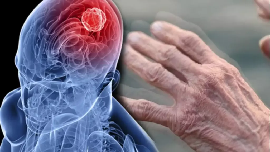 enfermedad de parkinson