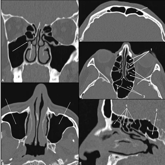 1668855459 Paranasal Sinus Computerised Tomography (PNS) Test