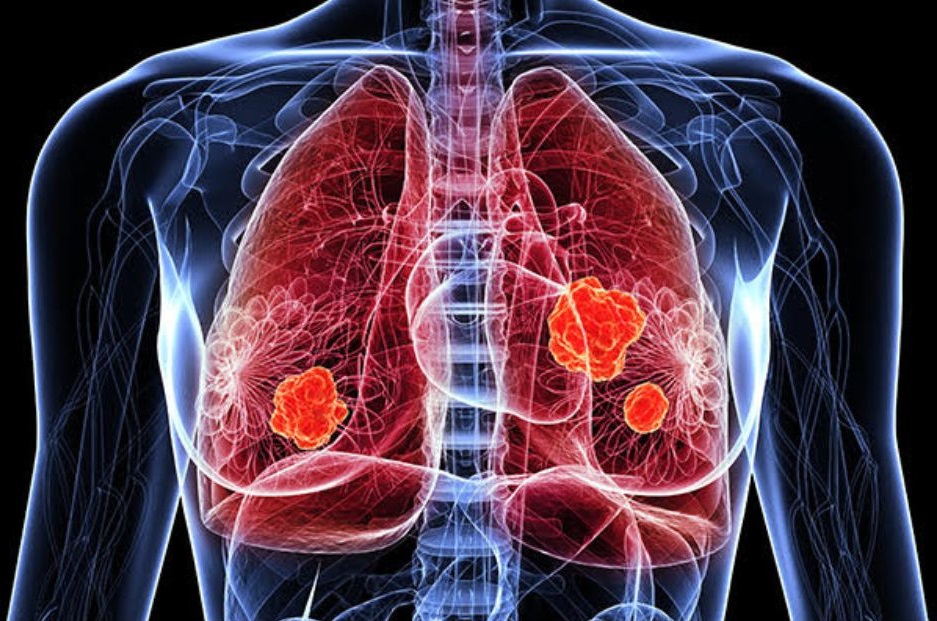 En 2024 se han producido avances en diagnostico molecular y tratamiento de precision en cancer de pulmon