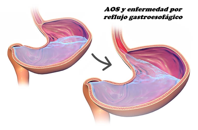iqd madrid reflujo gastroesofagico 01