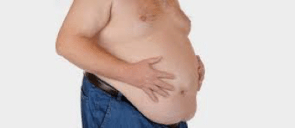 Figura 2 Obesidad central en sindrome de apnea hipopnea obstructiva del sueno Fuente