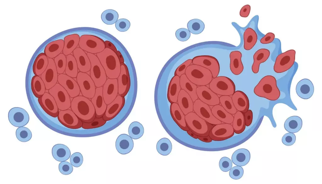 neoplasm