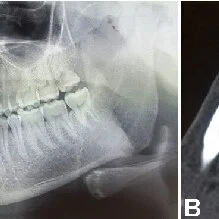 Preoperative radiographic evaluation of the anterior mandible fracture A Displacement of Q320