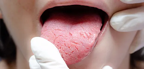 examining tongue surgery sleep apnea
